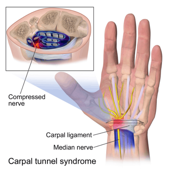Can Carpal Tunnel Syndrome be Service-Connected for Veterans? Screen Shot 2019 11 27 at 1.02.20 PM