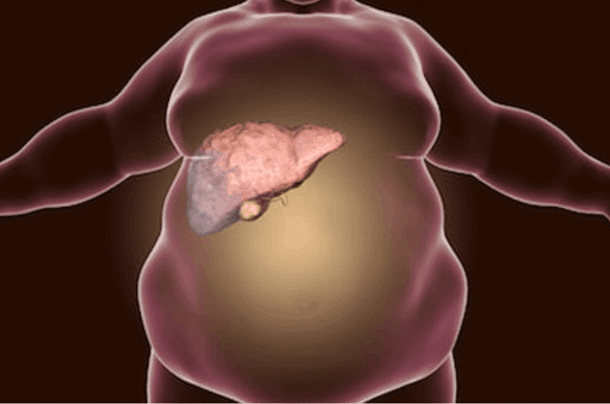 fatty liver disease in veterans